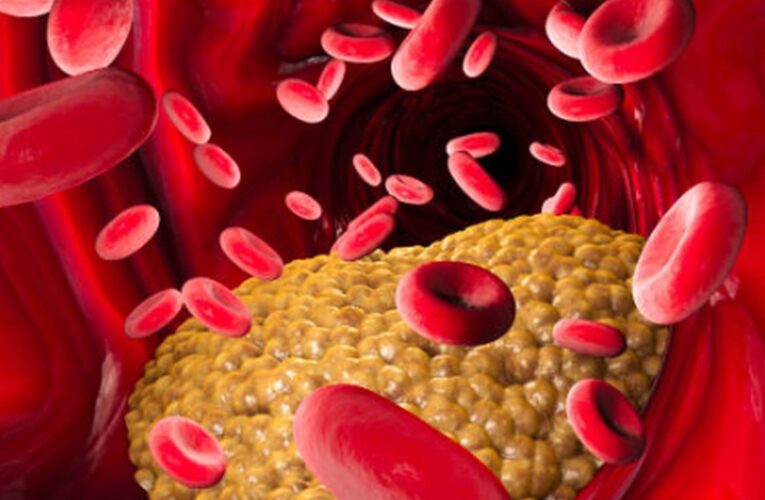 Медики назвали явные симптомы высокого холестерина