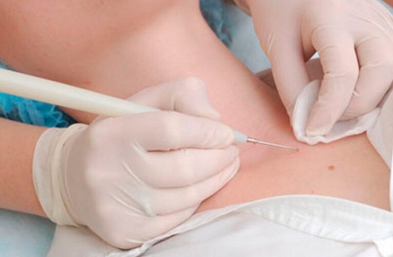 Как правильно избавиться от папиллом, объяснили дерматологи