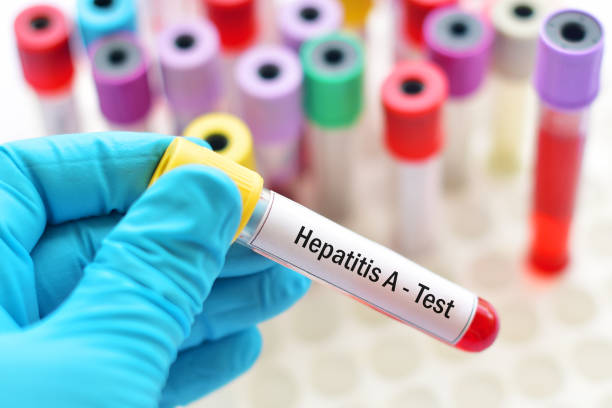 Вірусний гепатит А поширюється Україною, лікар розповів як не заразитися